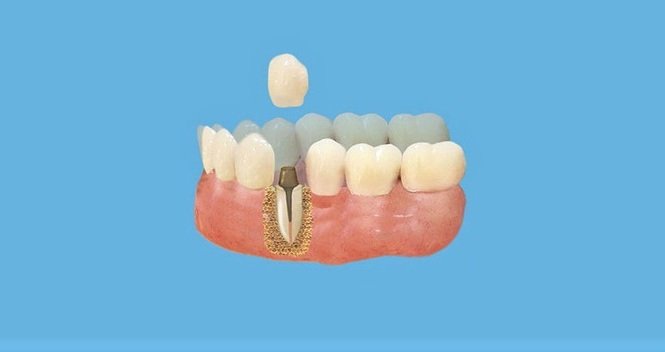 Преимущества протезирования зубов культевыми вкладками